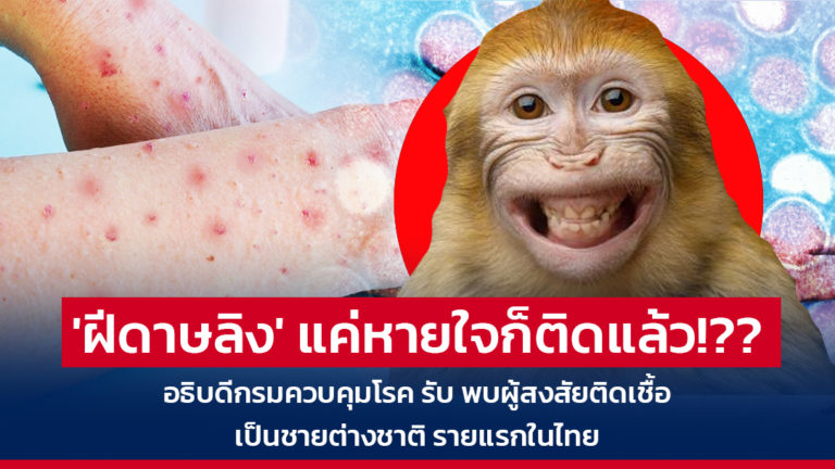 ‘ฝีดาษลิง’ แค่หายใจก็ติดแล้ว!?? อธิบดีกรมควบคุมโรค รับ พบผู้สงสัยติดเชื้อเป็นชายต่างชาติ รายแรกในไทย